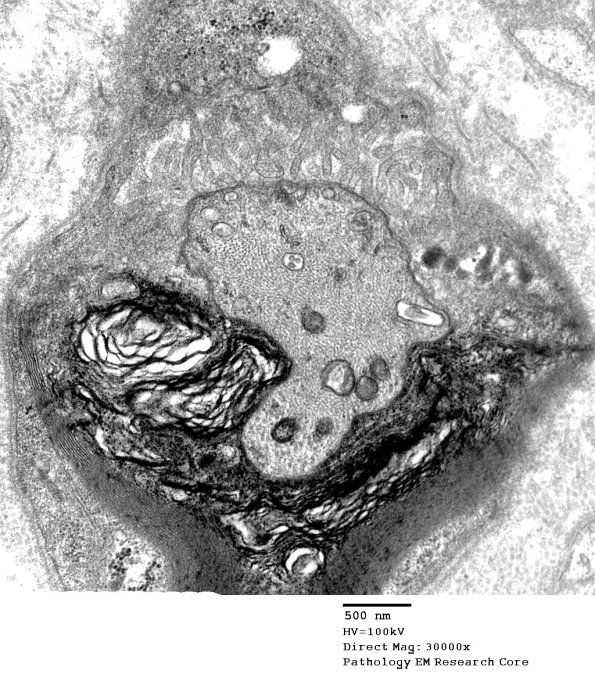 9A1 Node of Ranvier, half myelinated, subaxolemmal densities (Case 8)  - Copy