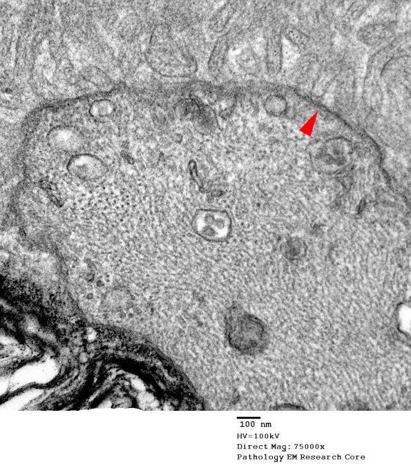 9A2 Node of Ranvier, subaxolemmal densities (Case 8) EM 035 copy - Copy