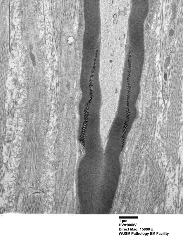 2A1 W24-3671 Anders G (Case 2) Sural_050 - Copy