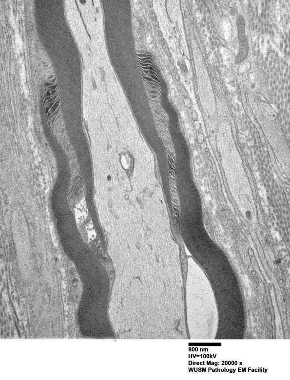 2A2 W24-3671 Anders G (Case 2) Sural_057 - Copy