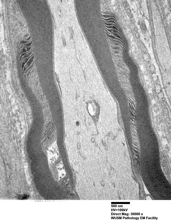 2A3 W24-3671 Anders G (Case 2) Sural_058 - Copy