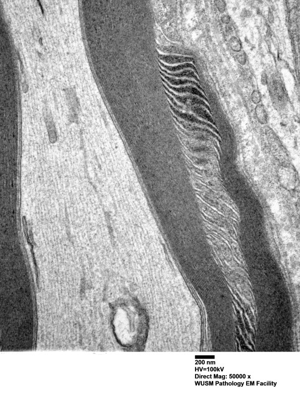 2A4 W24-3671 Anders G (Case 2) Sural_060 - Copy