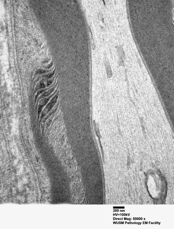 2A5 W24-3671 Anders G (Case 2) Sural_059 - Copy