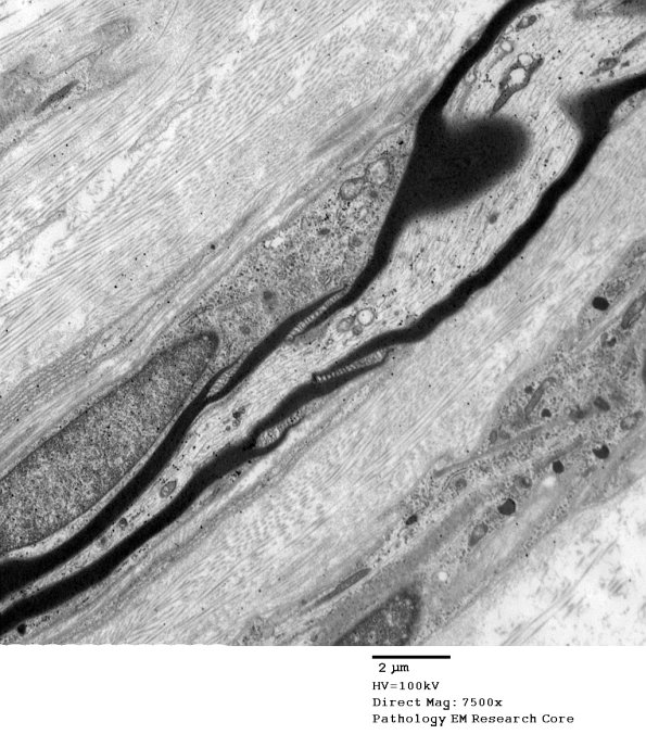 3A1 Schmidt-Lanterman cleft, Diabetic NP (Case 3) EM 029 - Copy