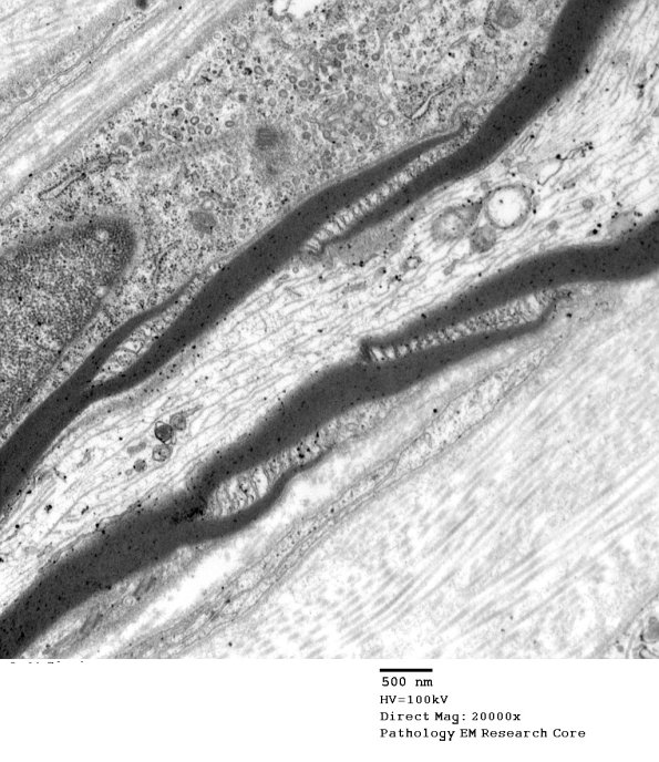 3A2 Schmidt-Lanterman cleft, Diabetic NP (Case 3) EM 032 - Copy