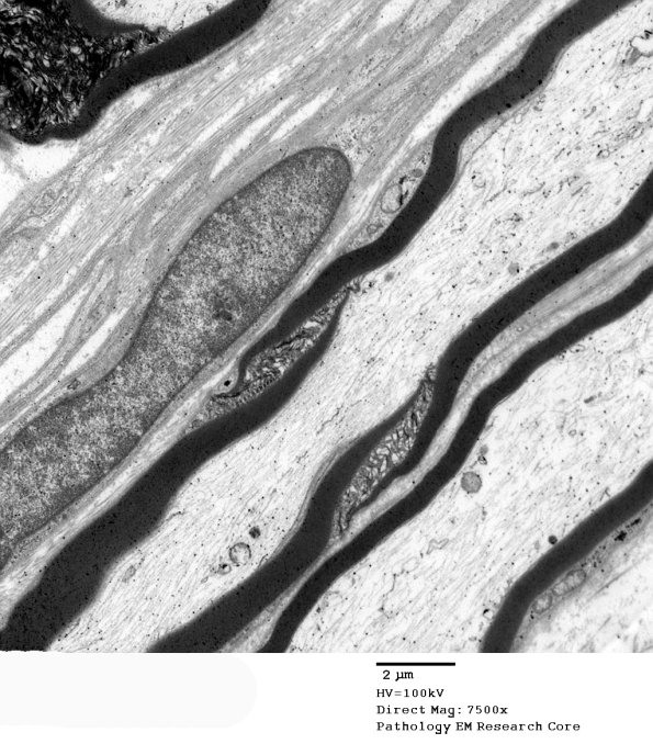 3A3 Schmidt-Lanterman cleft, diabetic NP (Case 3) EM 062 - Copy