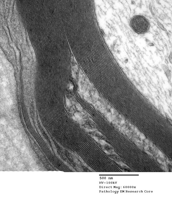 4A2 Schmidt-Lanterman clefts (Case 4) - Copy