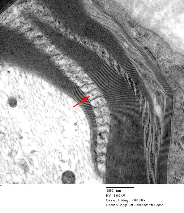4A4 Schmidt-Lanterman clefts Paraprotein (Case 4)_054 2 copy.jpg