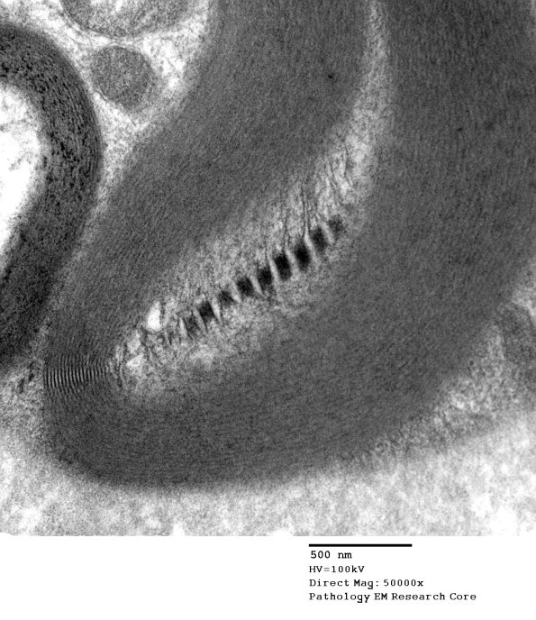 4B2 Schmidt-Lanterman cleft Paraprotein NP (Case 4) - Copy