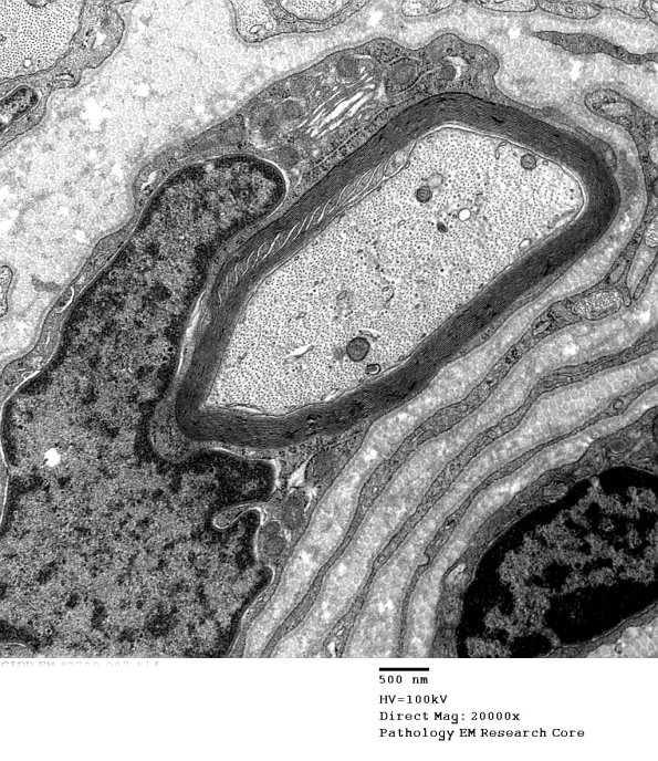 5A1 Schmidt Lanterman cleft CIDP (Case 5)_007A - Copy