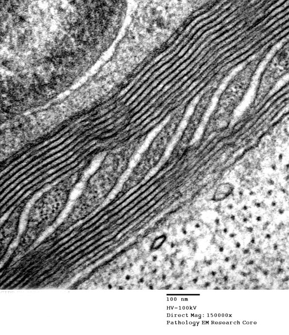 5A2 Schmidt Lanterman cleft CIDP (Case 5)_011A - Copy
