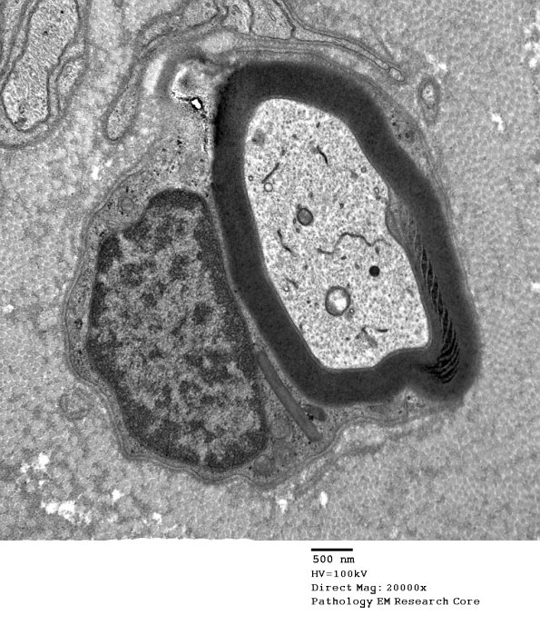 7A1 Schmidt-Lanterman Cleft (Case 7) EM 090 - Copy
