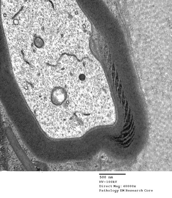 7A2 Schmidt-Lanterman Cleft (Case 7) EM 091 - Copy