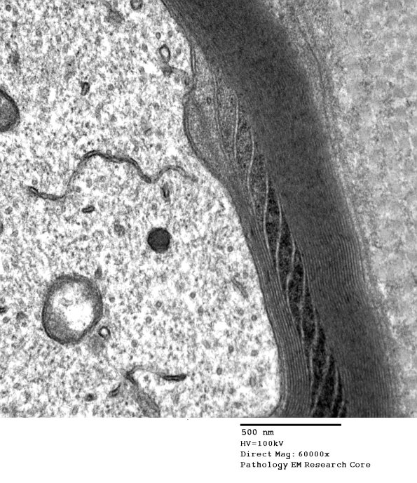 7A3 Schmidt-Lanterman Cleft (Case 7) EM 092 - Copy