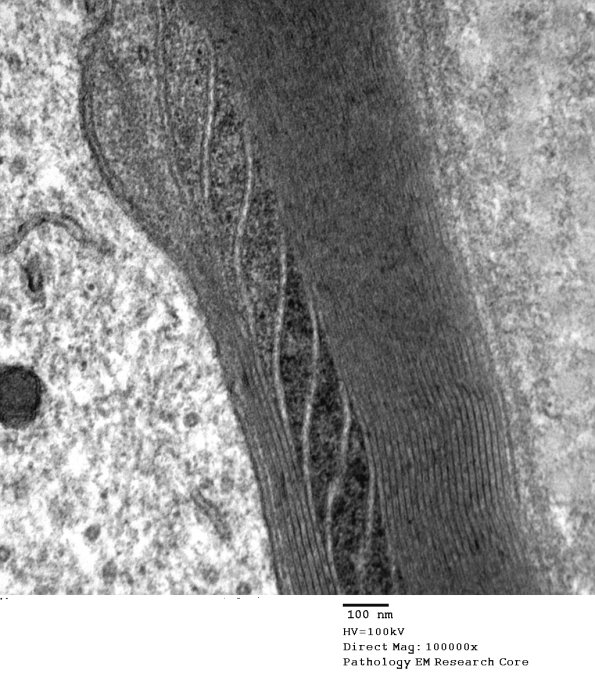 7A4 Schmidt-Lanterman Cleft (Case 7) EM 093 - Copy