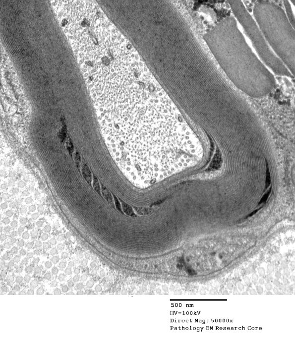 7B2 Schmidt-Lanterman Cleft (Case 7) EM 044 - Copy