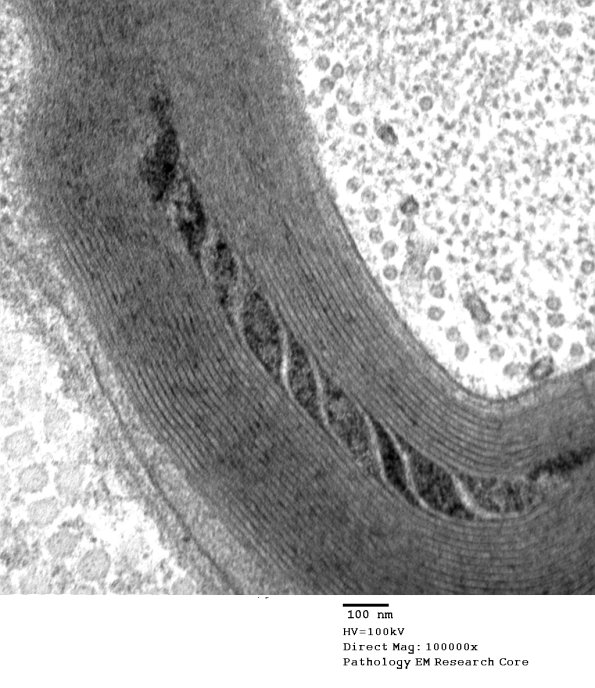 7B3 Schmidt-Lanterman Cleft (Case 7) EM 045 - Copy