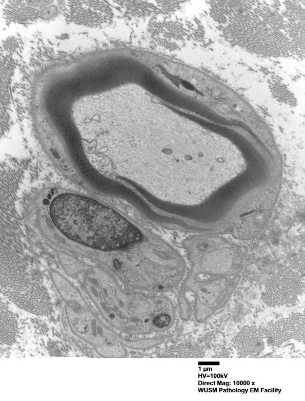 8A1 Schmidt-Lanterman Clefts (Case 8) EM 011 - Copy