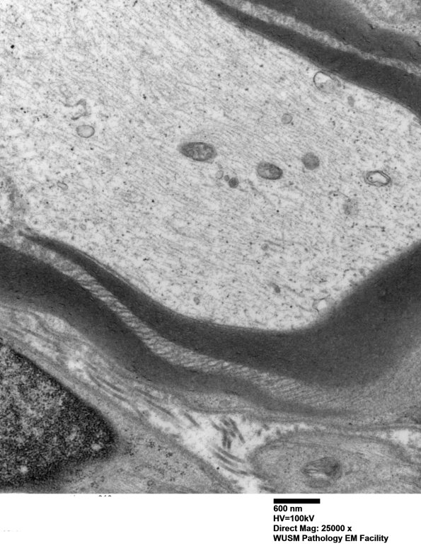 8A2 Schmidt-Lanterman Clefts (Case 8) EM 012 - Copy