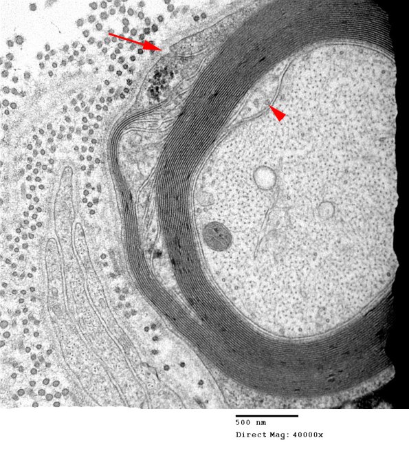 9A Schmidt-Lanterman Cleft  (Case 9) EM 015 - Copy copy