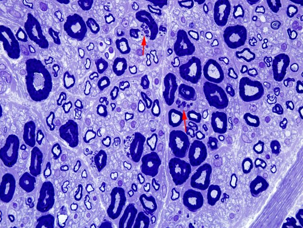 1A1 Pi granules (Case 1) Plastic 6.jpg