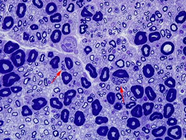 1A2 Pi granules (Case 1) Plastic 7 copy