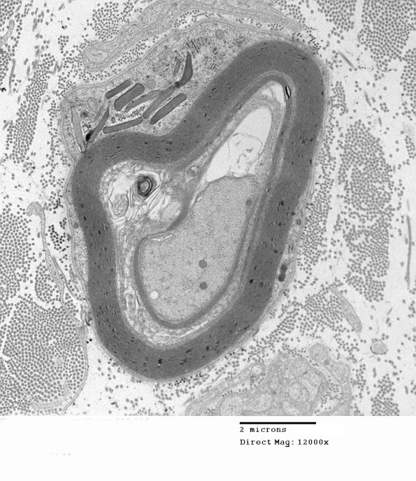 2A1 (Case 2)  EM017 - Copy