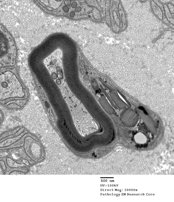 3A1 Schmidt-Lanterman Cleft (Case 3) EM 049 - Copy
