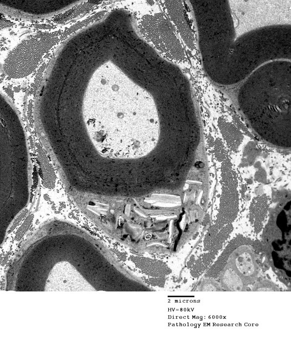 5A1 Normal axon, sural (Case 5) EM 021 - Copy
