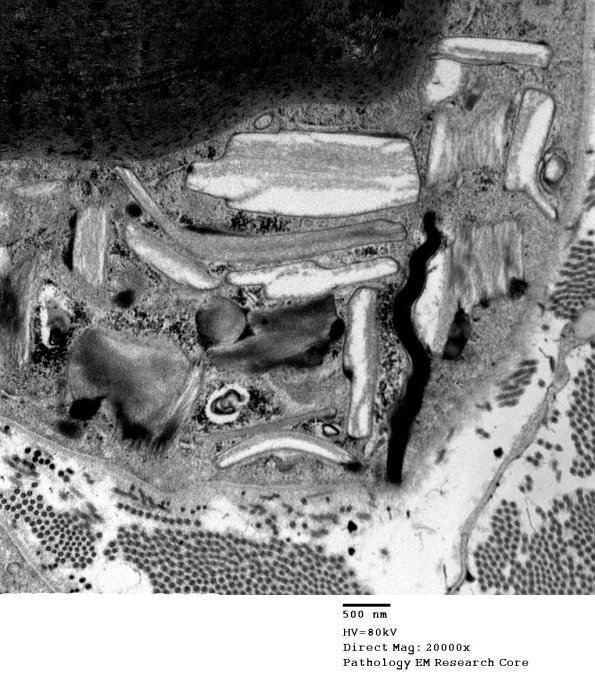 5A2 Normal axon, sural (Case 5) EM 022 - Copy