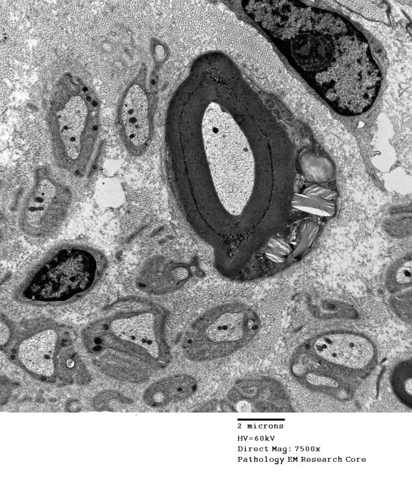 6A1 Normal nerve, Pi granules (Case 6) EM 2 - Copy