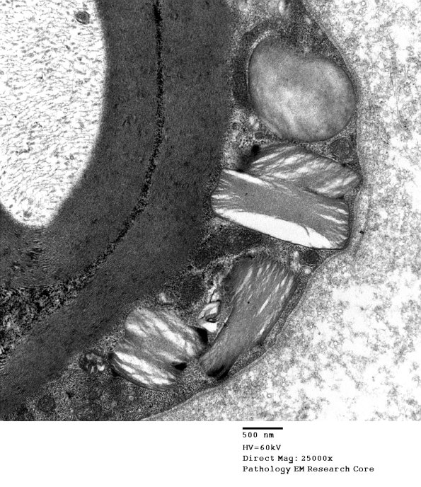 6A2 Normal nerve, Pi granules (Case 6) EM 1 - Copy