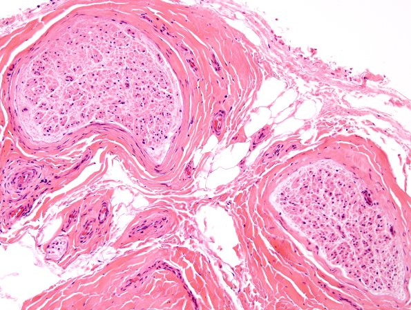 10A1 Axonal degeneration (Case 10) H&E 1