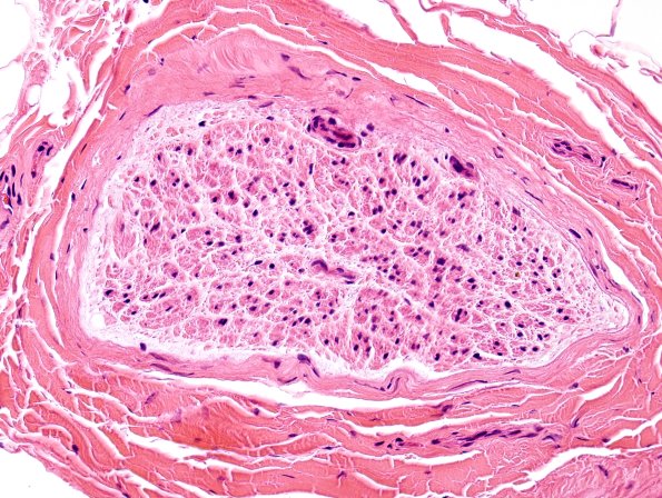 10A2 Axonal degeneration (Case 10) H&E