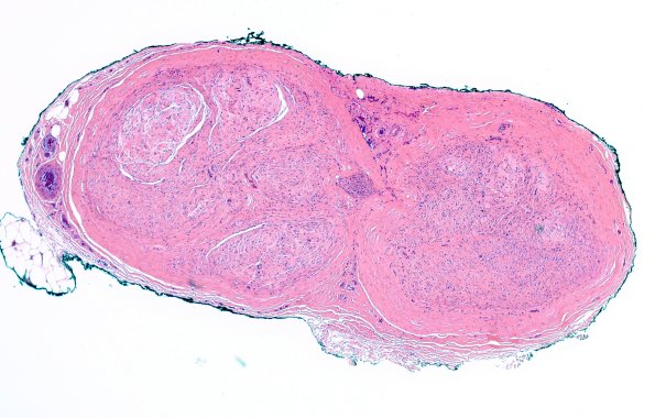 11A1 Fibrosis (Case 11) H&E 1