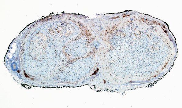 11B1 Fibrosis (Case 11) EMA 3