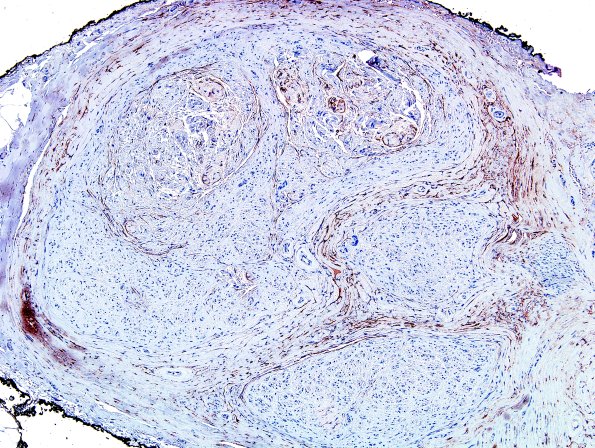 11B2 Fibrosis (Case 11) EMA 2