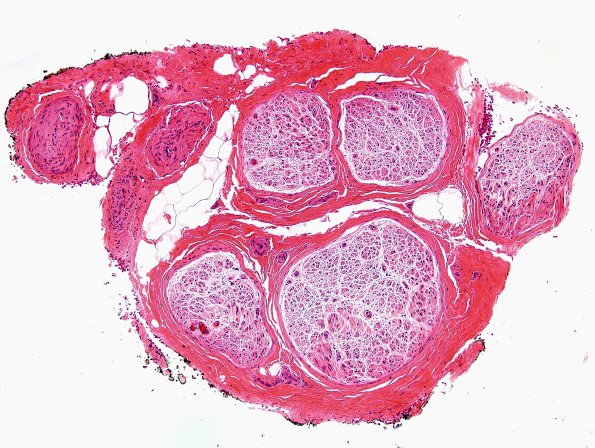 12A1 End Stage Nerve (Case 12) H&E 1