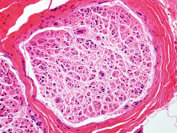 12A2 End Stage Nerve (Case 12) H&E 2