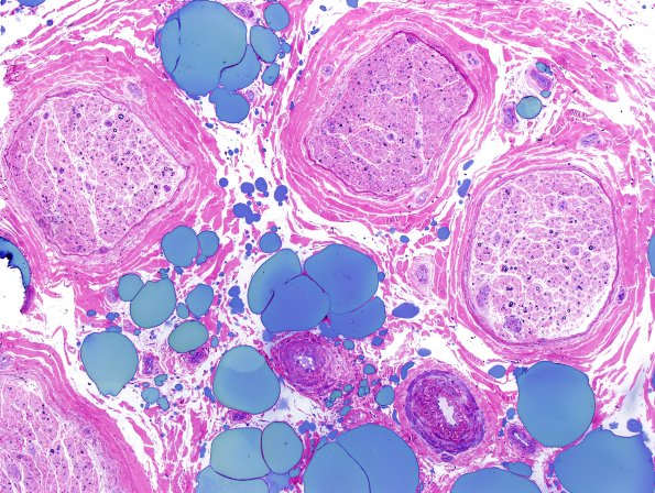 13A1 Pyronine Thionine Stain (Case 13) Plastic 6.jpg