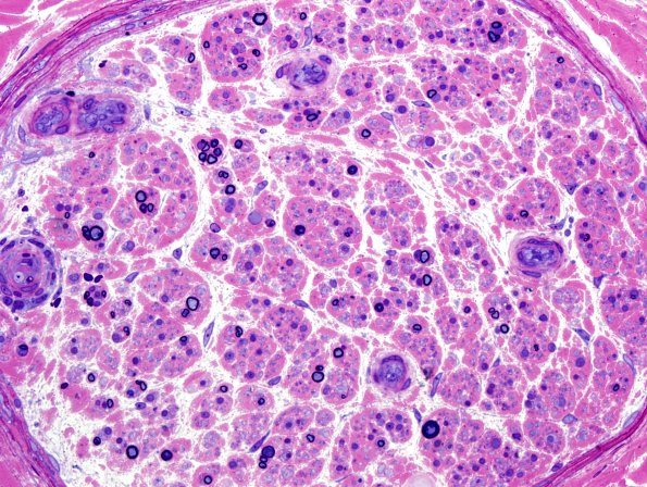 13A4 Pyronine Thionine Stain (Case 13) Plastic 2.jpg