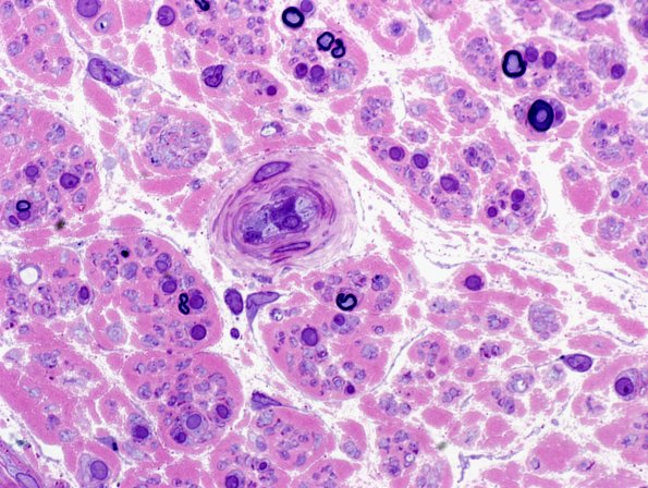 13A5 Pyronine Thionine Stain (Case 13) Plastic 7.jpg