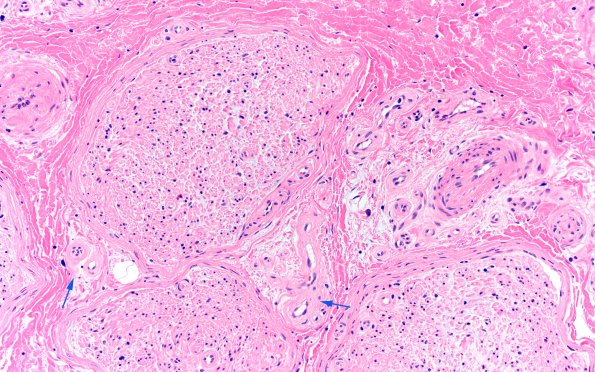 14A2 End Stage Nerve (Case 14) H&E 20X copy