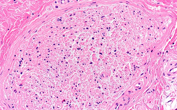 14A3 End Stage Nerve (Case 14) H&E 40X 2