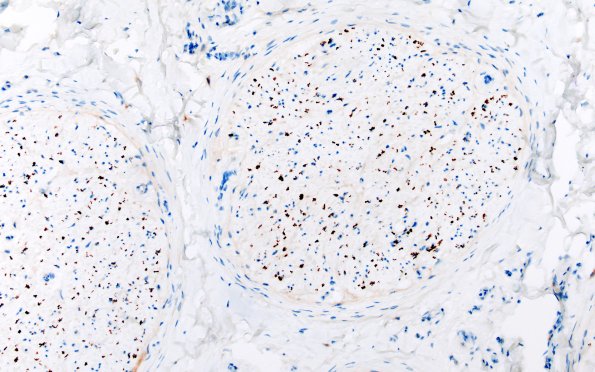 14B1 End Stage Nerve (Case 14) NF 20X