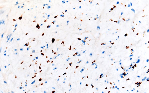 14B2 End Stage Nerve (Case 14) NF 60X