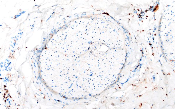 14C End Stage Nerve (Case 14) CD45 20X 3