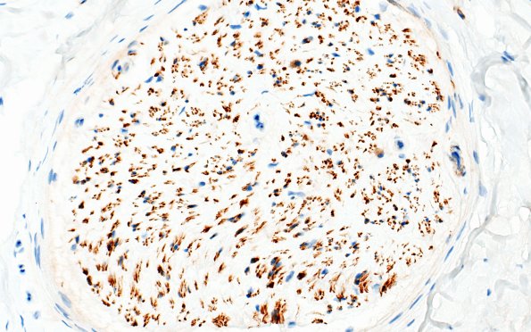 14D End Stage Nerve (Case 14) CD56 40X 2