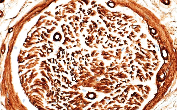 14E End Stage Nerve (Case 14) Coll IV 40X