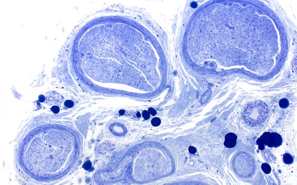 14F1 End Stage Nerve (Case 14) Plastic 10X